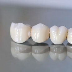 Dental Bridges