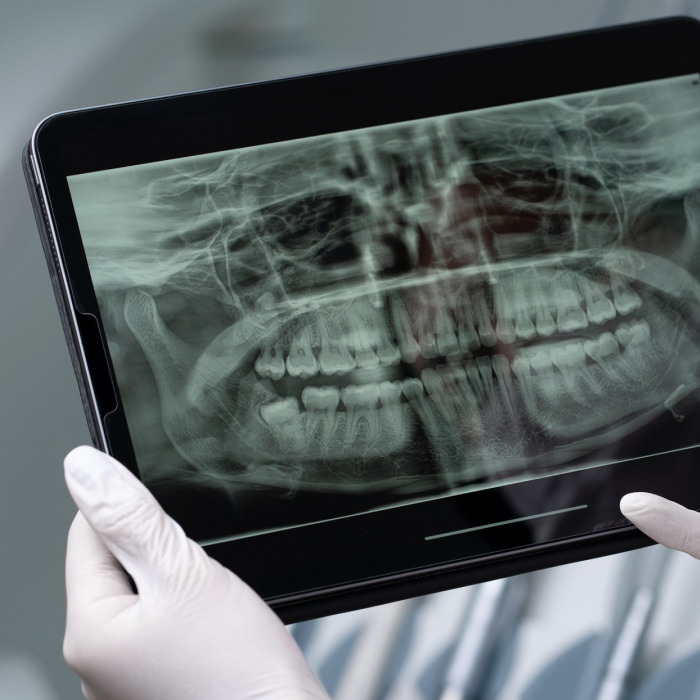 Digital X rays